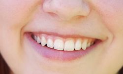 Gülüş tasarımı tedavisinde diş implantı