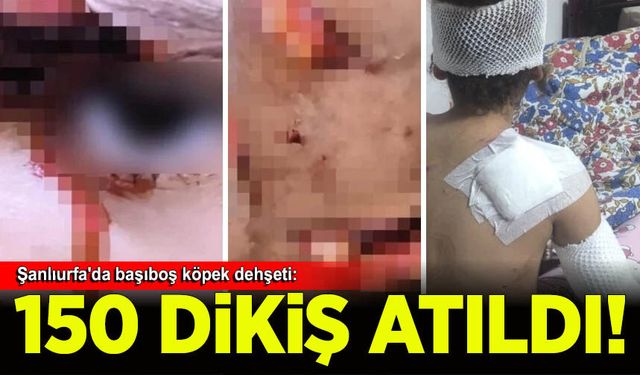 Şanlıurfa'da başıboş köpeklerin saldırısına uğrayan çocuğa 150 dikiş atıldı