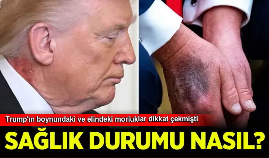 Trump'ın sağlık durumu nasıl? Boynundaki morluklar dikkat çekmişti